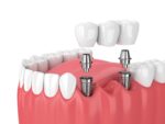 Citycentre | URBN Dental Implants & Snoring Treatment