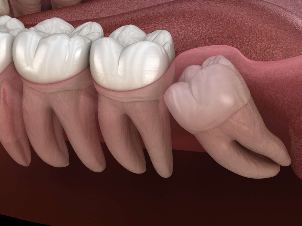 affordable wisdom tooth extraction